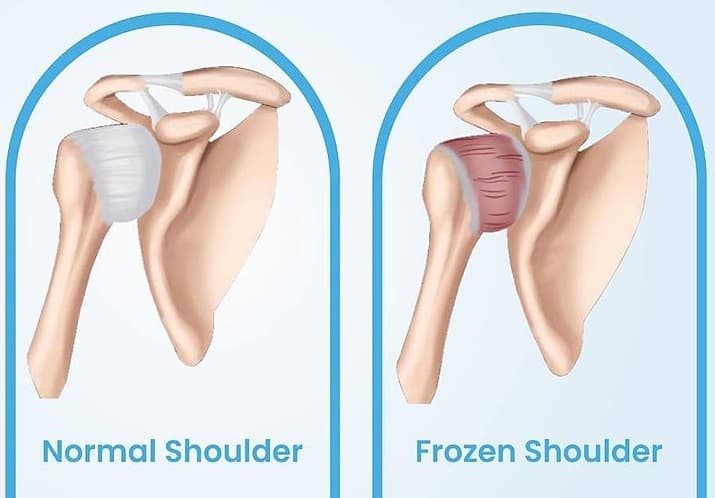 Frozen Shoulder Vs Normal Shoulder