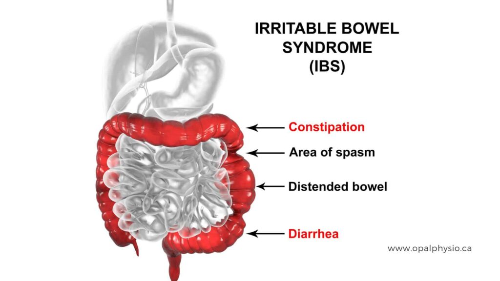 Illustration of Digestive System Suffering From Irritable Bowel Syndrome