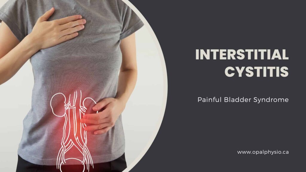 Interstitial Cystitis - Painful Bladder Syndrome