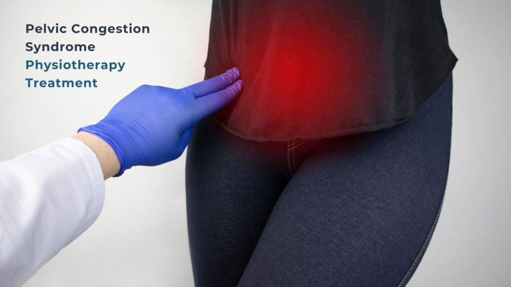 Pelvic Congestion Syndrome Physiotherapy Treatment