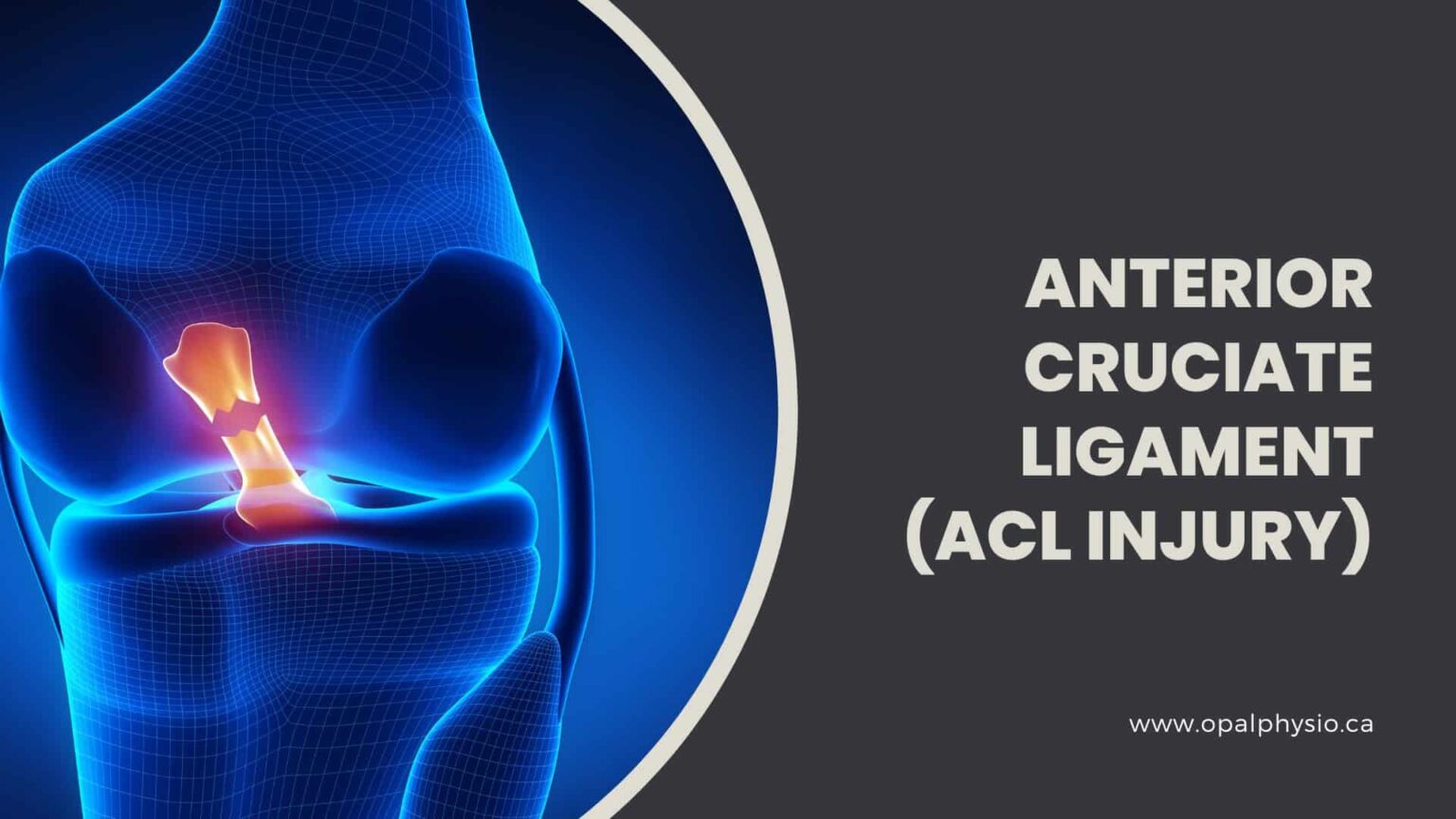Anterior Cruciate Ligament ACL Injury