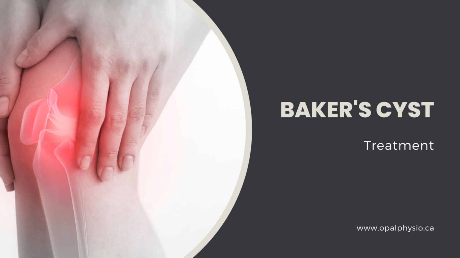 Baker's Cyst
