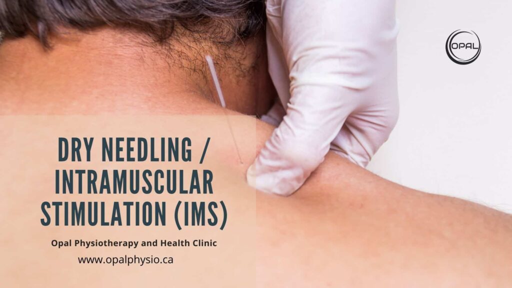 Dry Needling _ Intramuscular Stimulation _ IMS