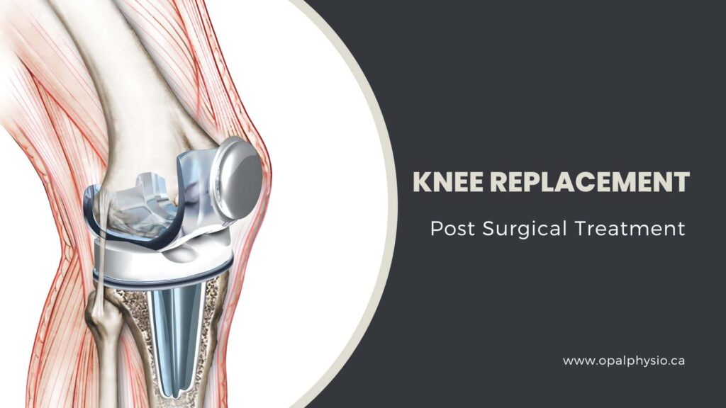 Knee Replacement Surgery Treatment