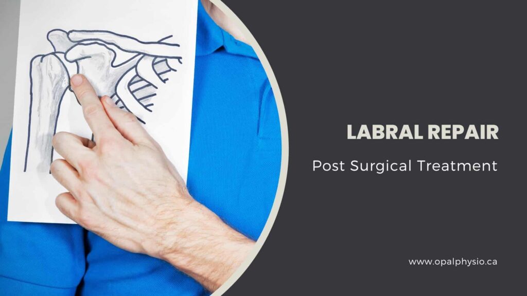 Labral Repair Post Surgical Treatment