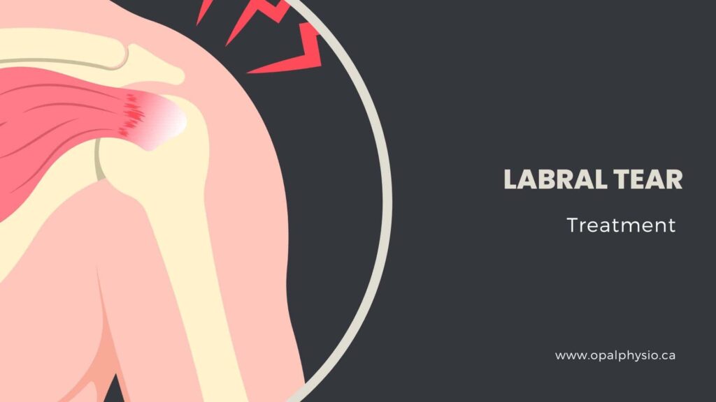 Labral Tear Treatment