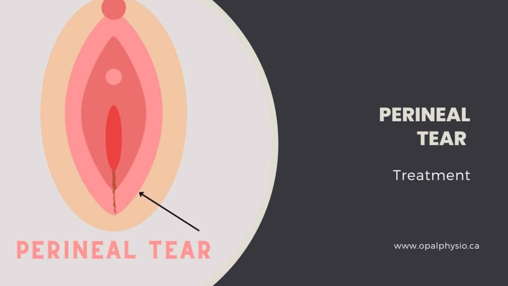 Perineal Tear Treatment